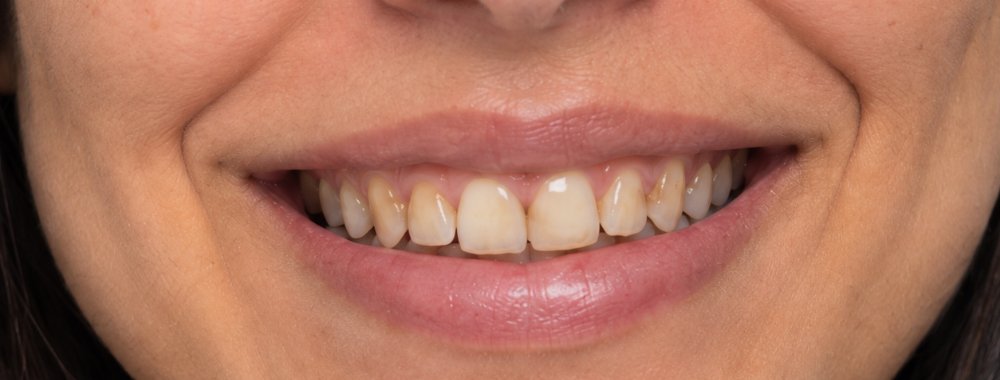 Sorriso antes do clareamento dental