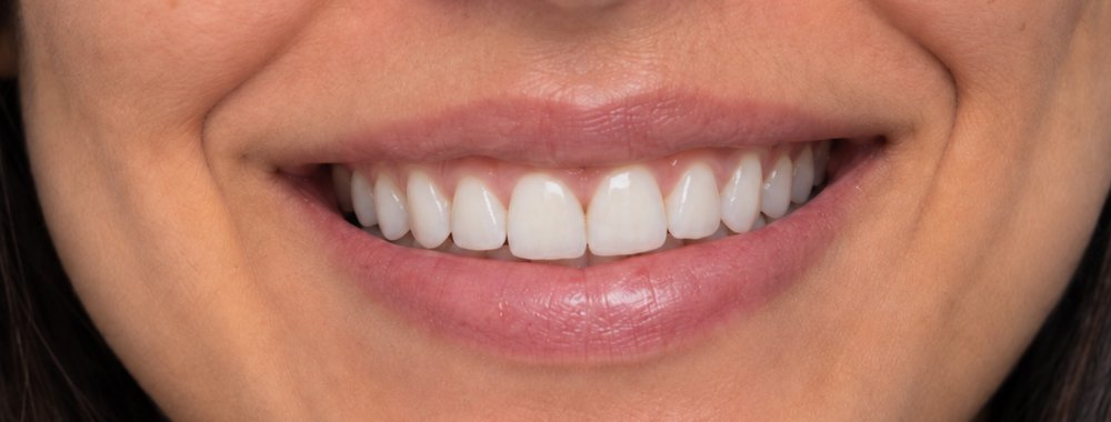 O mesmo sorriso depois do clareamento dental